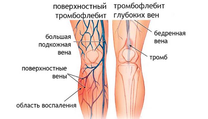 Лечение флеботромбоза нижних конечностей