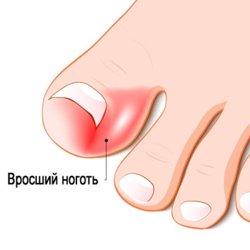 Симптомы врастания ногтя