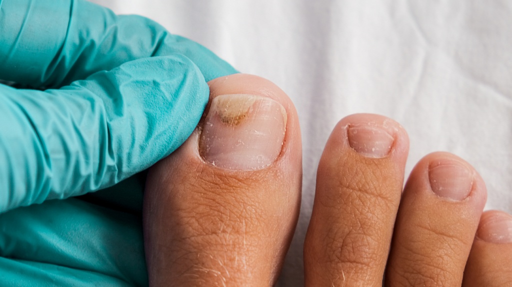 Причины возникновения горбинки на ногте и способы ее устранения